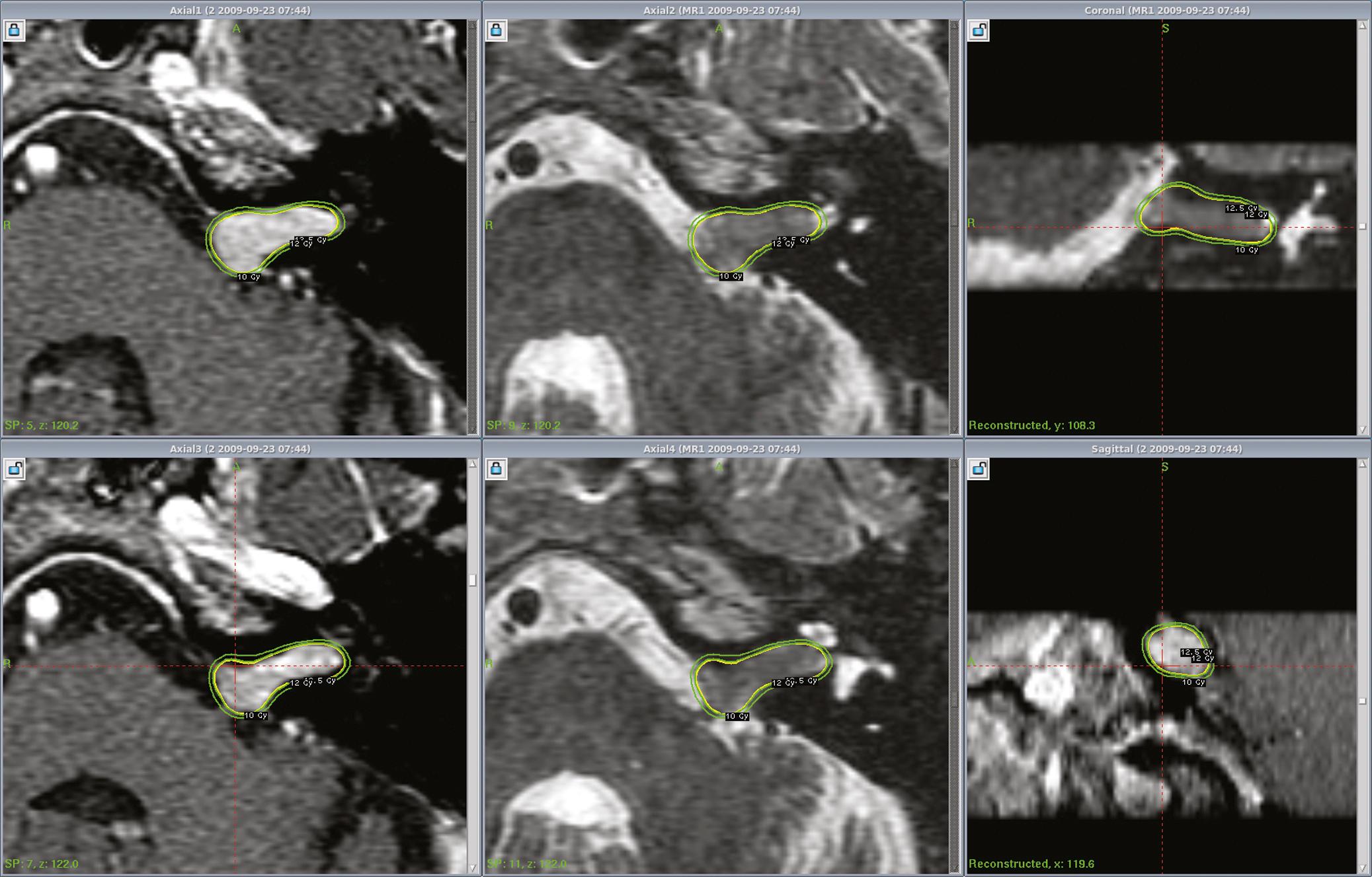 FIGURE. 94.3, MR images at Gamma Knife radiosurgery in a 60-year-old man with a vestibular schwannoma that caused hearing loss. The dose plan is shown using the Perfexion Gamma Knife to a margin dose of 12.5 Gy. Short- and long-relaxation time images help to define both the tumor and the cochlea.