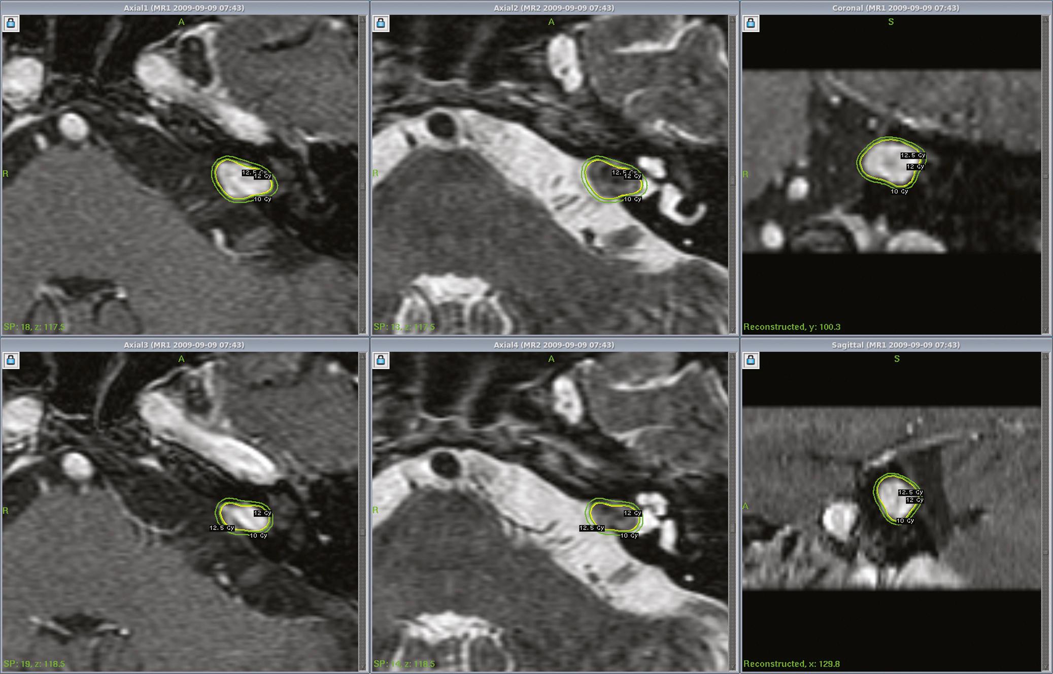 FIGURE. 94.4, MR images at Gamma Knife radiosurgery in a man with an intracanalicular vestibular schwannoma. The dose plan is shown using the Perfexion Gamma Knife to a margin dose of 12.5 Gy. The relationship between the tumor and the inner ear structures are well seen using these imaging sequences.