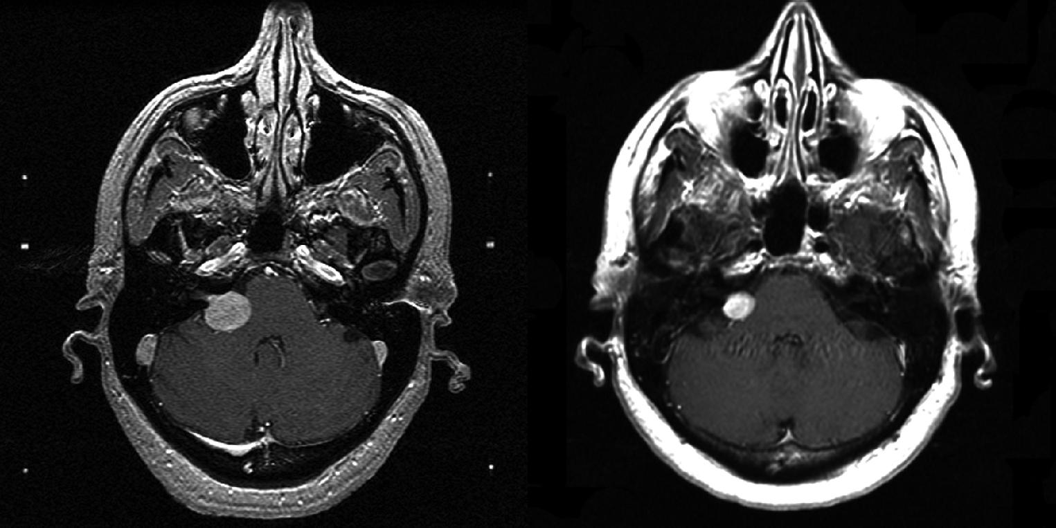 FIGURE. 94.5, MR images (at radiosurgery, left ) and 5 years later (right) in a 58-year-old woman with a right vestibular schwannoma. Tumor regression is noted. Her audiogram at presentation showed a speech discrimination score (SDS) of 100% and pure tone average (PTA) of 15 dB. At 5 years, her SDS was 100% and PTA was 20 dB.