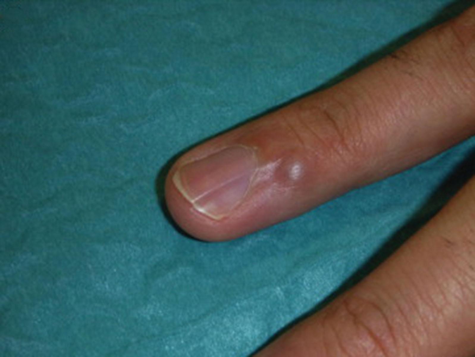 Fig. 15.1, Glomus tumor of index finger.