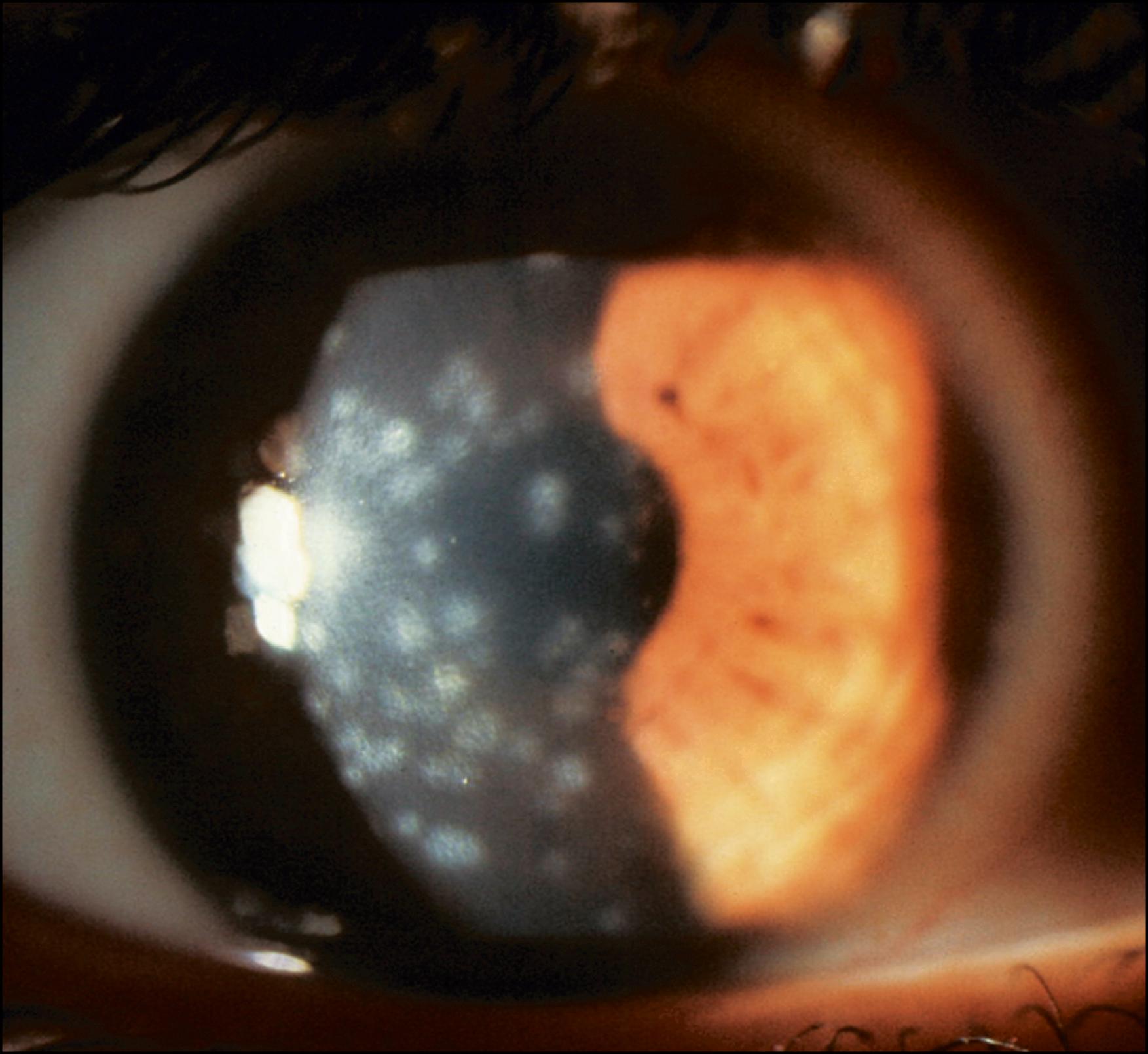 Fig. 38.4, Stage IV adenoviral keratitis (third week).