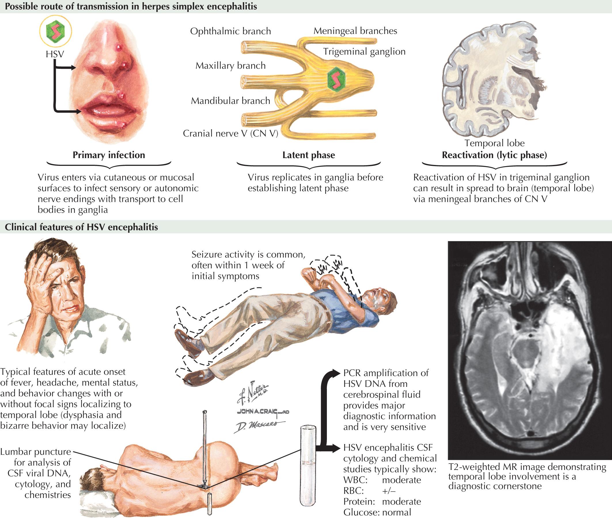 Fig. 45.1, HSV Encephalitis.