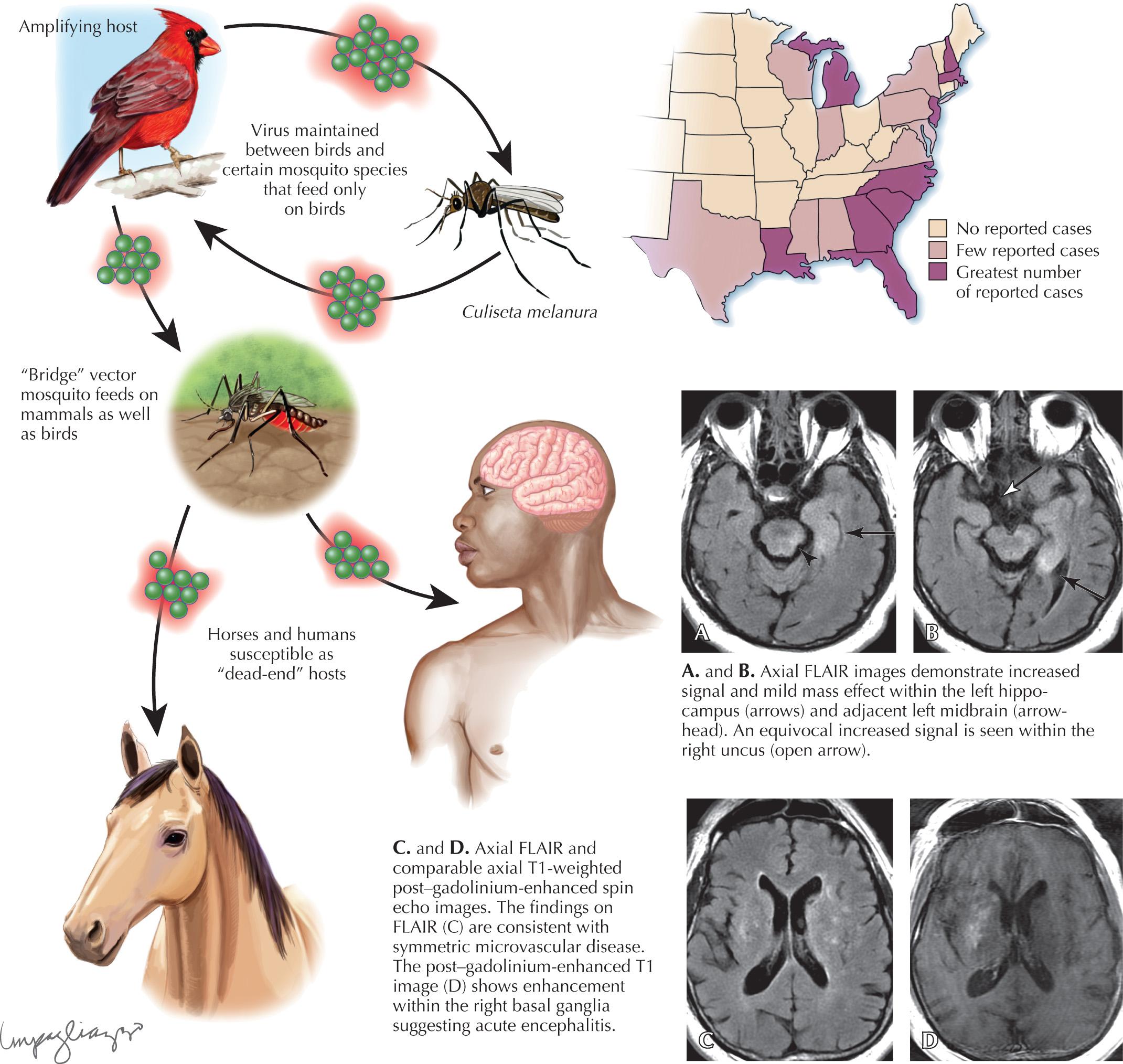 Fig. 45.3, Eastern Equine Encephalitis.