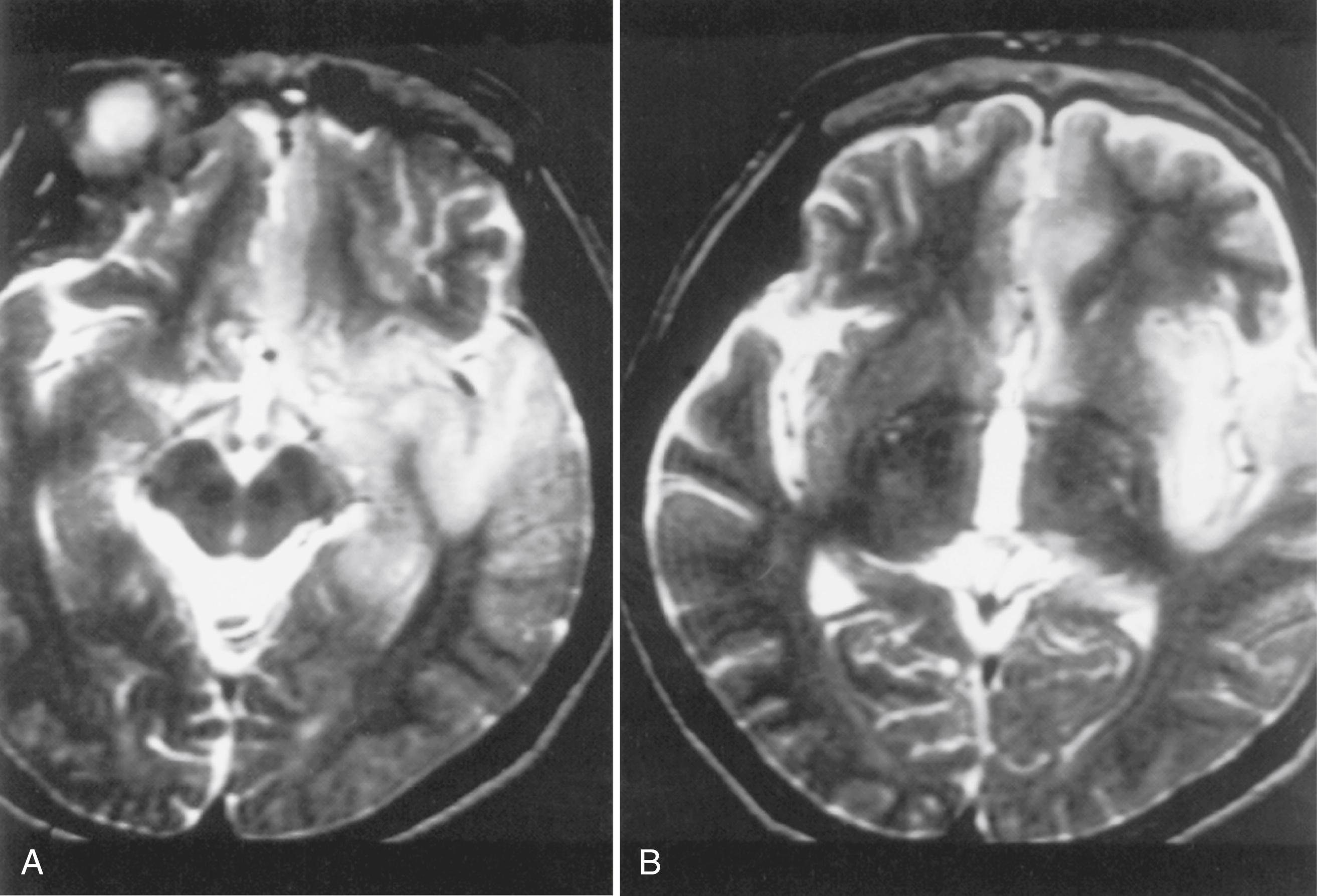 Fig. 78.1, Herpes Simplex Encephalitis.