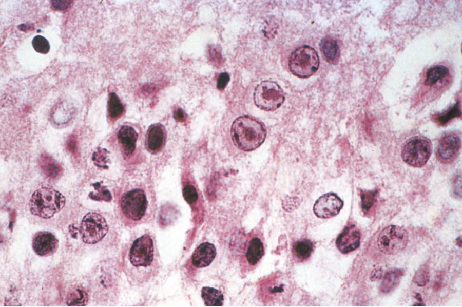 Fig. 78.2, Hippocampal Granule Cell Neurons in Herpes Simplex 1 Encephalitis.