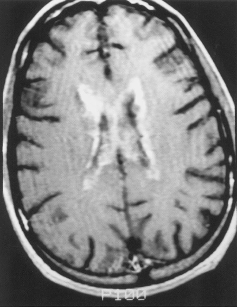 Fig. 78.3, Human Cytomegalovirus Ventriculitis.