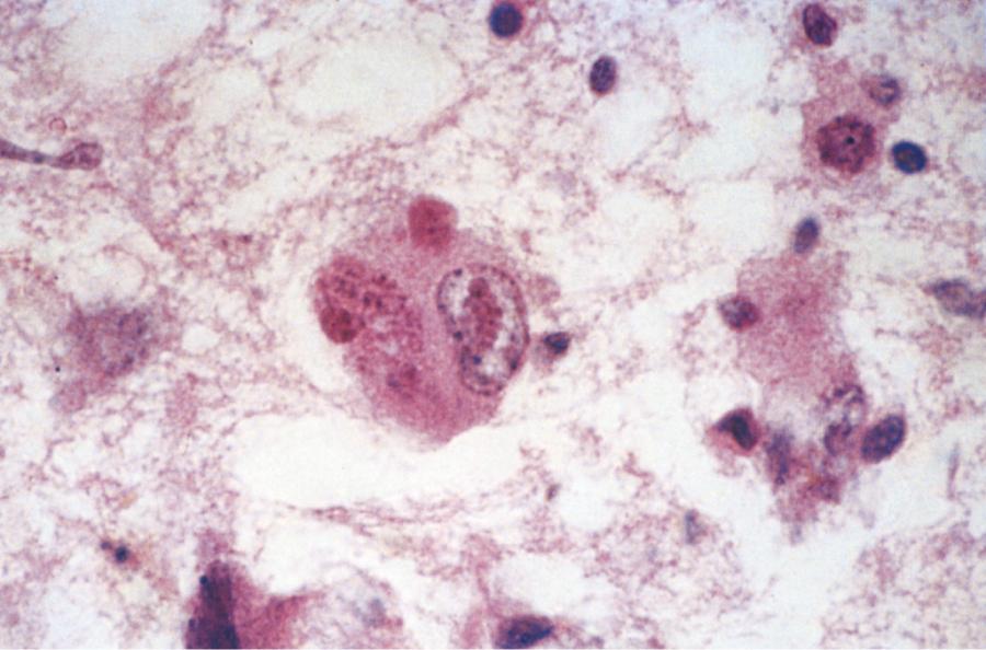 Fig. 78.4, Ballooned Cell with Eccentric Nucleus in Human Cytomegalovirus Encephalitis.