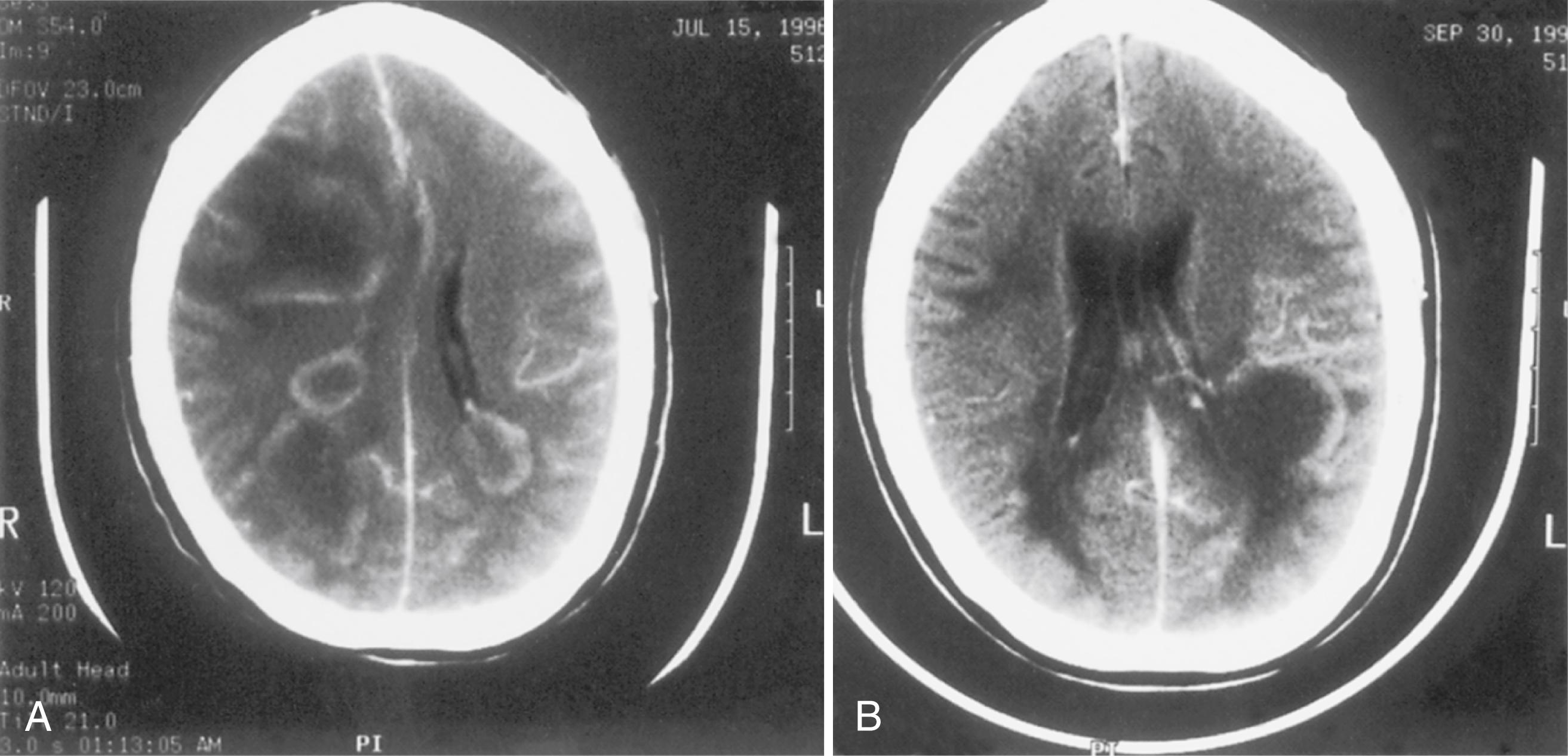 Fig. 78.5, Concurrent Human Herpesvirus Type 6 and Human Immunodeficiency Virus Disease.