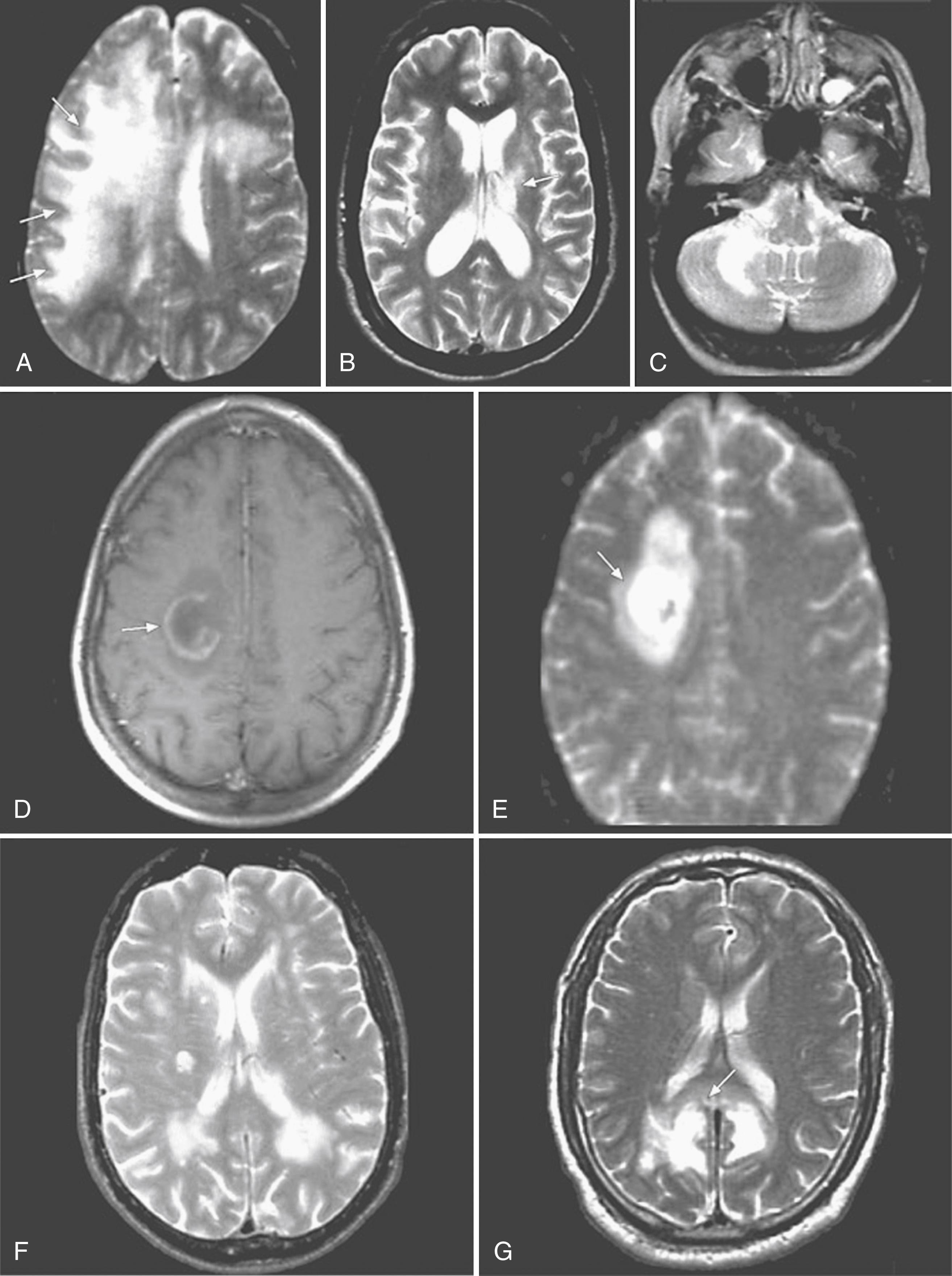 Fig. 78.6, Progressive Multifocal Leukoencephalopathy Brain Magnetic Resonance Imaging Lesion Patterns.