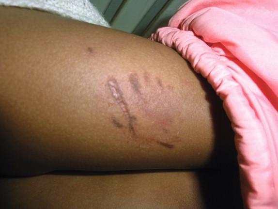 Figure 8-1, Image of dog bite with associated erythema from a young patient in Addis Ababa, Ethiopia.