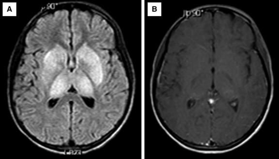 Figure 8-2, A, MRI imaging shows widespread T2 hyperintensity within the thalamus and basal ganglia of a 15-year-old rabies survivor. B, These hyperintense changes are not seen on T1 imaging taken at approximately the same level.