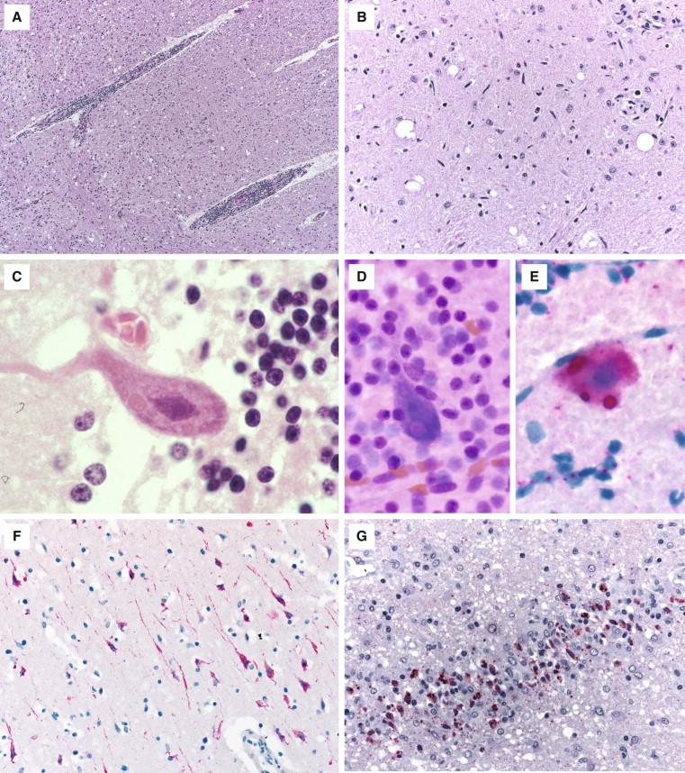 Figure 8-3, Rabies encephalitis. Meningoencephalitis with prominent perivascular cuffing (50 ×) (A) and gliosis with Babes nodules and elongate glial cells present in the medulla (200 ×) (B) . Negri bodies are seen within Purkinje cells by H&E (1000 ×) (C) and on an air-dried Diff-Quick stained smear of cerebellum (630 ×) (D) . Rabies virus antigen (stained red) demonstrated within a Purkinje cell by virus-specific IHC in a fresh cerebellum smear (630 ×) (E) ; antigen can be seen in neurons of the cerebellum (200 ×) (F) and hippocampus (200 ×) (G) by IHC.