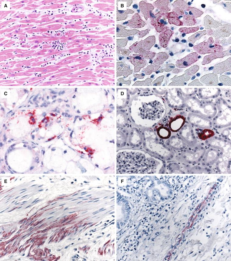 Figure 8-5, Rabies systemic involvement. Myocarditis can be seen (200 ×) (A) with rabies virus antigen (stained red) localized to the myocardium (400 ×) (B) by IHC. Rabies antigen (stained red) may also be seen within salivary gland epithelium (630 ×) (C) , renal tubular cells (200 ×) (D) , smooth muscle (200 ×), (E) endothelium (200 ×), and (F) by IHC.