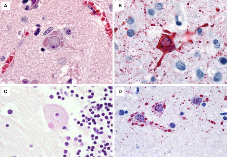 Figure 8-7, Other neuronal cytoplasmic viral inclusions can mimic Negri bodies. A, Cytoplasmic inclusions can be present in subacute sclerosing panencephalitis (630 ×). B, Measles virus antigen (stained red) demonstrated by IHC (400 ×). C, In Nipah virus encephalitis inclusions can closely resemble Negri bodies (1000 ×). D, Nipah virus antigen (stained red) demonstrated by IHC (1000 ×).