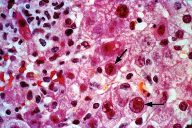 Fig. 65-1, Adenovirus hepatitis showing characteristic intranuclear inclusion bodies.