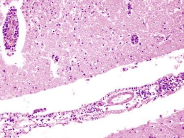 Fig 1, Viral meningoencephalitis. An infiltrate of mononuclear cells is present within the leptomeninges and extends to involve the perivascular space of superficial blood vessels.