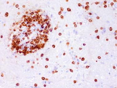 Fig 5, Viral encephalitis. An immunohistochemical study for CD3 reveals perivascular and parenchymal T lymphocytes.