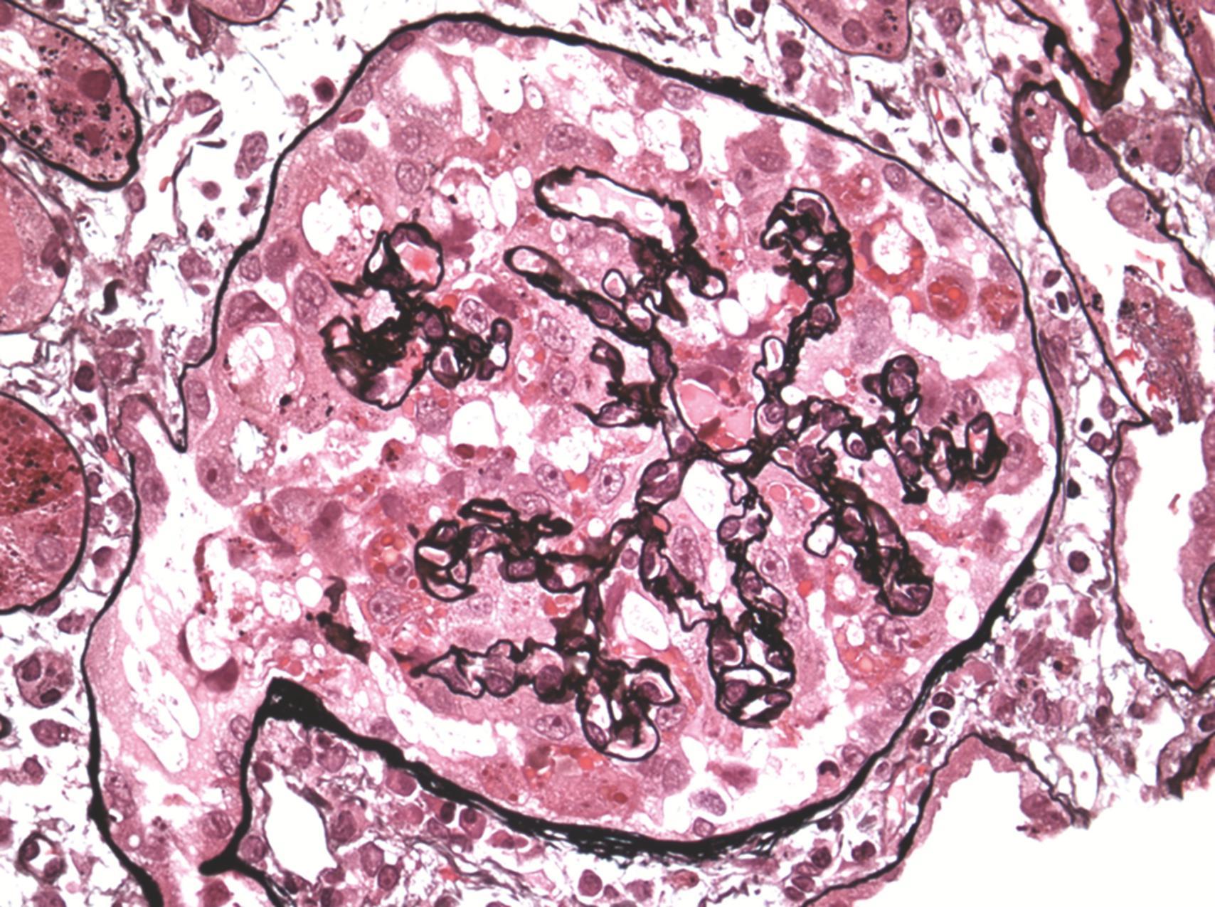 Fig. 24.1, Collapsing focal segmental glomerulonephritis in human immunodeficiency virus–associated nephropathy (Jones methenamine silver stain, ×400).