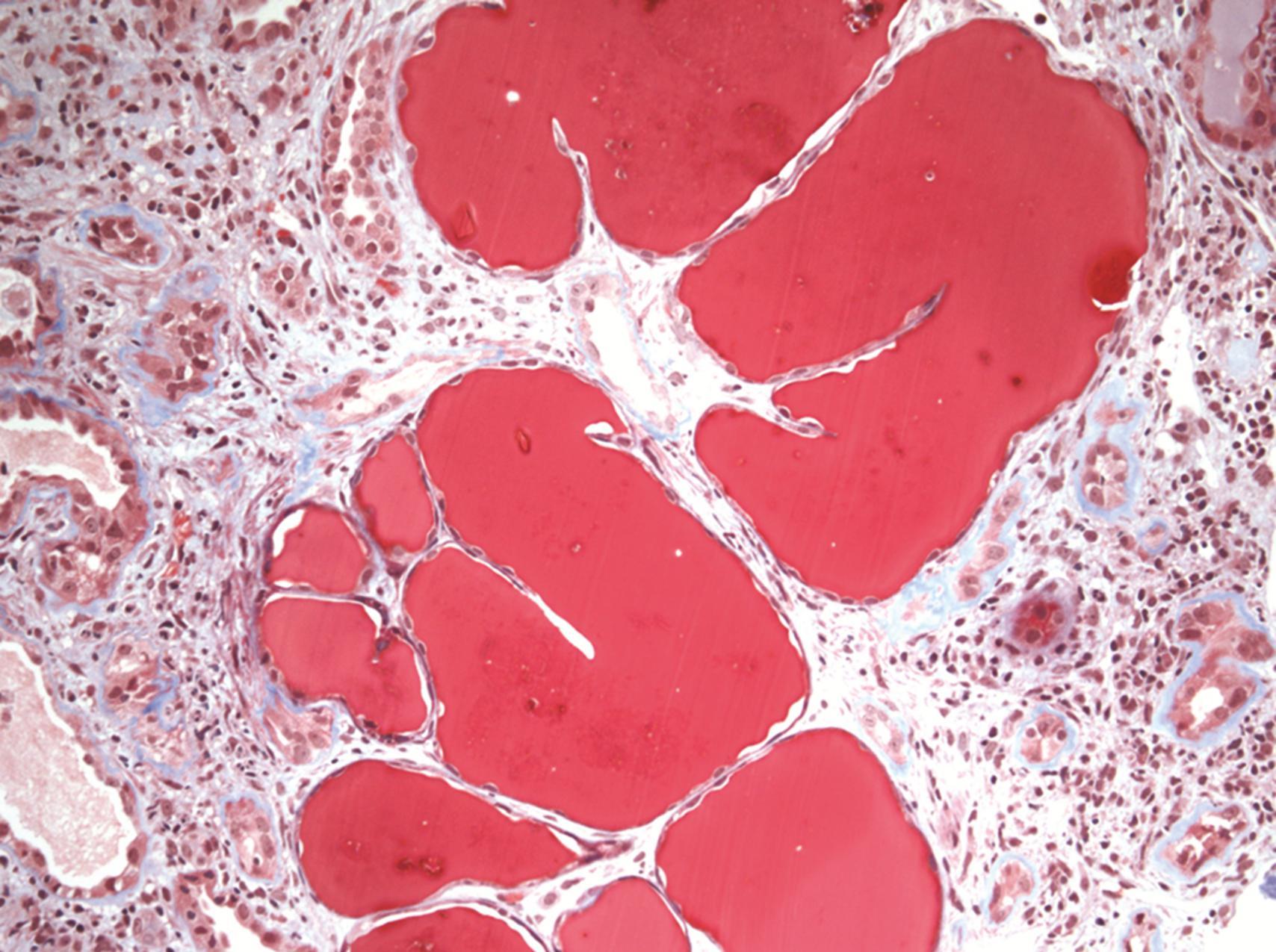 Fig. 24.2, Tubulointerstitial disease in human immunodeficiency virus–associated nephropathy, characterized by tubular atrophy, microcystic tubular dilation with proteinaceous casts, and mild interstitial inflammation (trichrome stain, ×200).