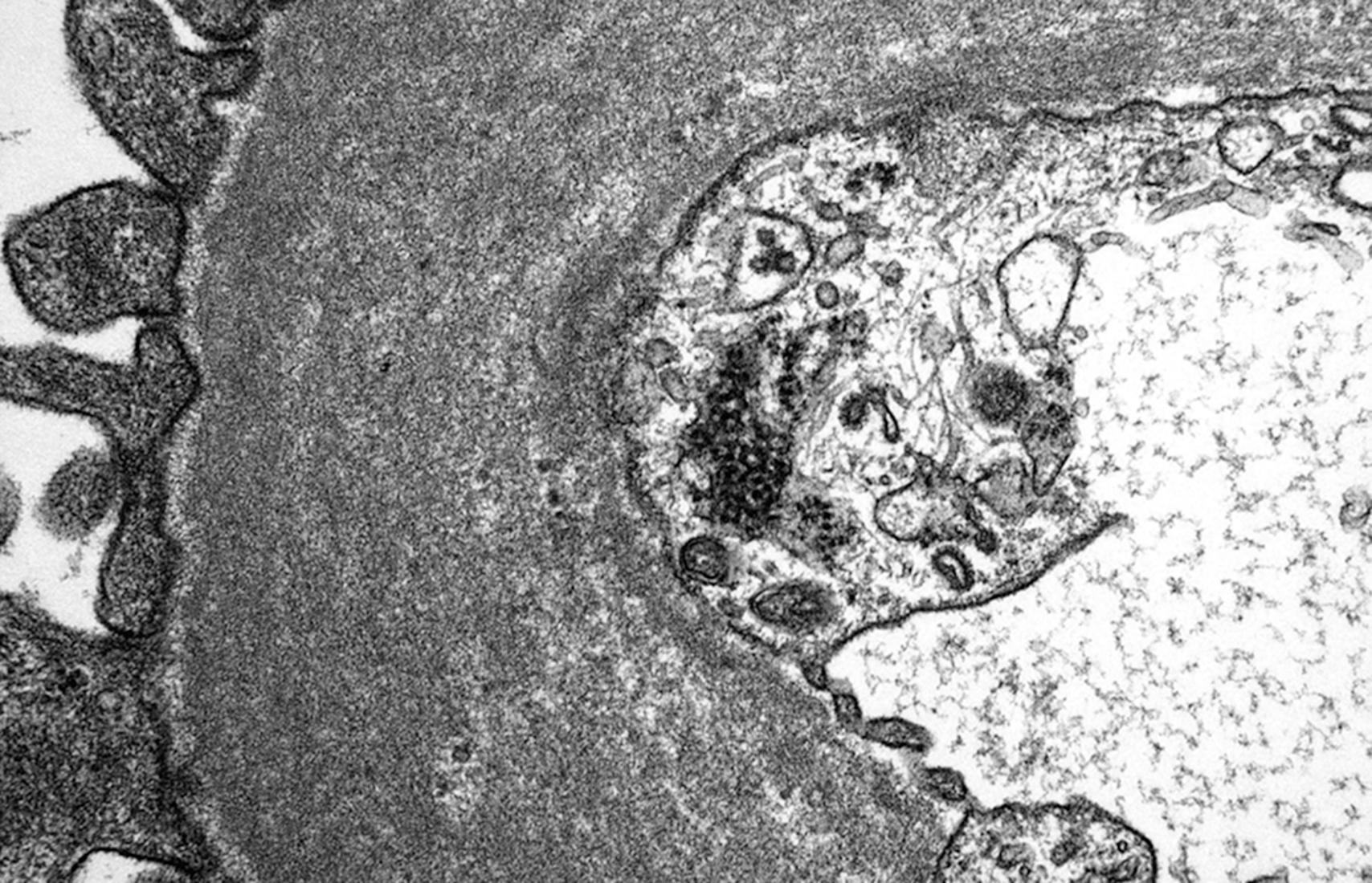 Fig. 24.3, Tubuloreticular inclusions in the endothelium classically seen on electron microscopy in human immunodeficiency virus–associated nephropathy (electron micrograph, ×50,000).