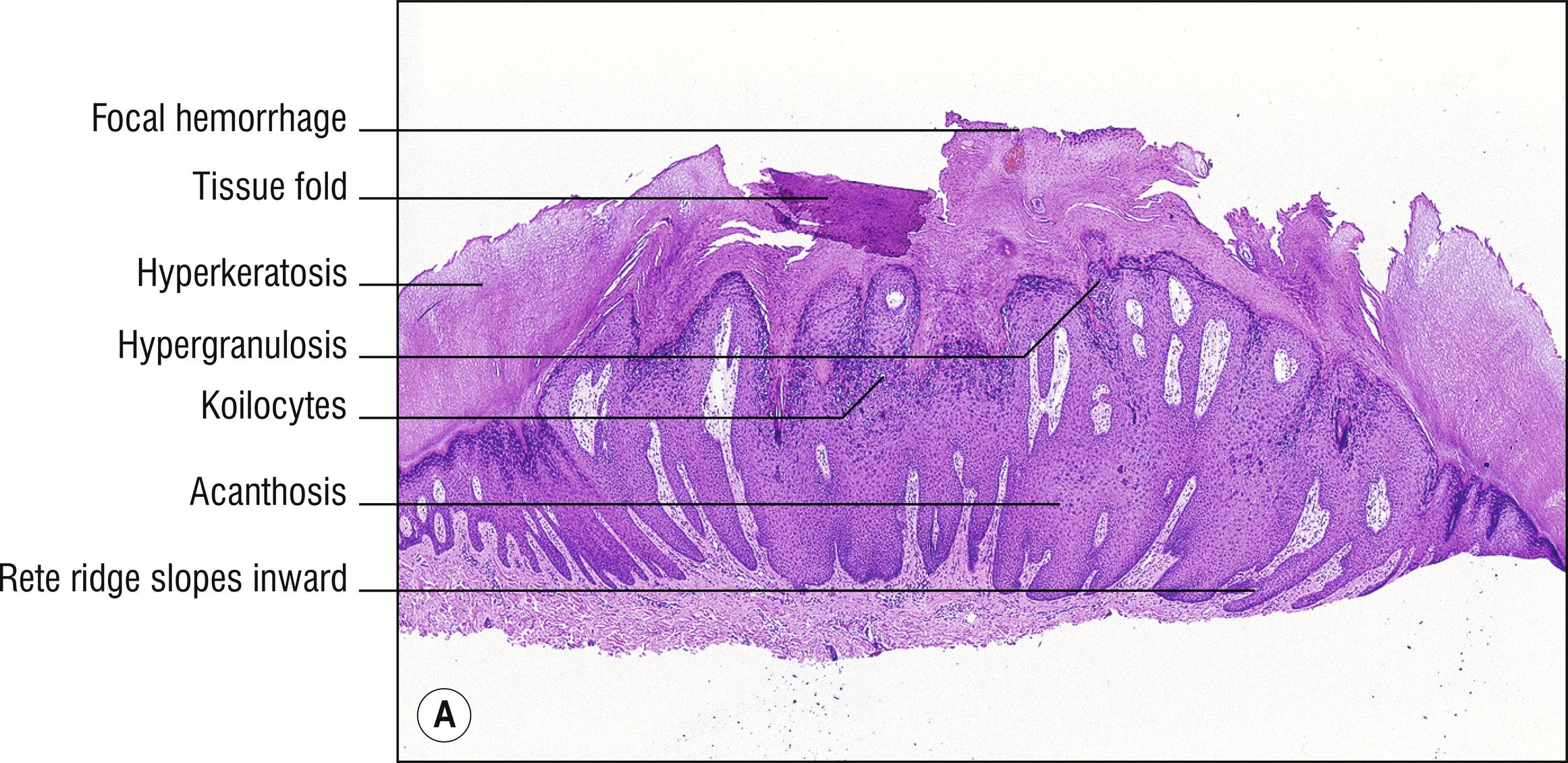 Fig. 14.1, A Verruca vulgaris (low mag.).