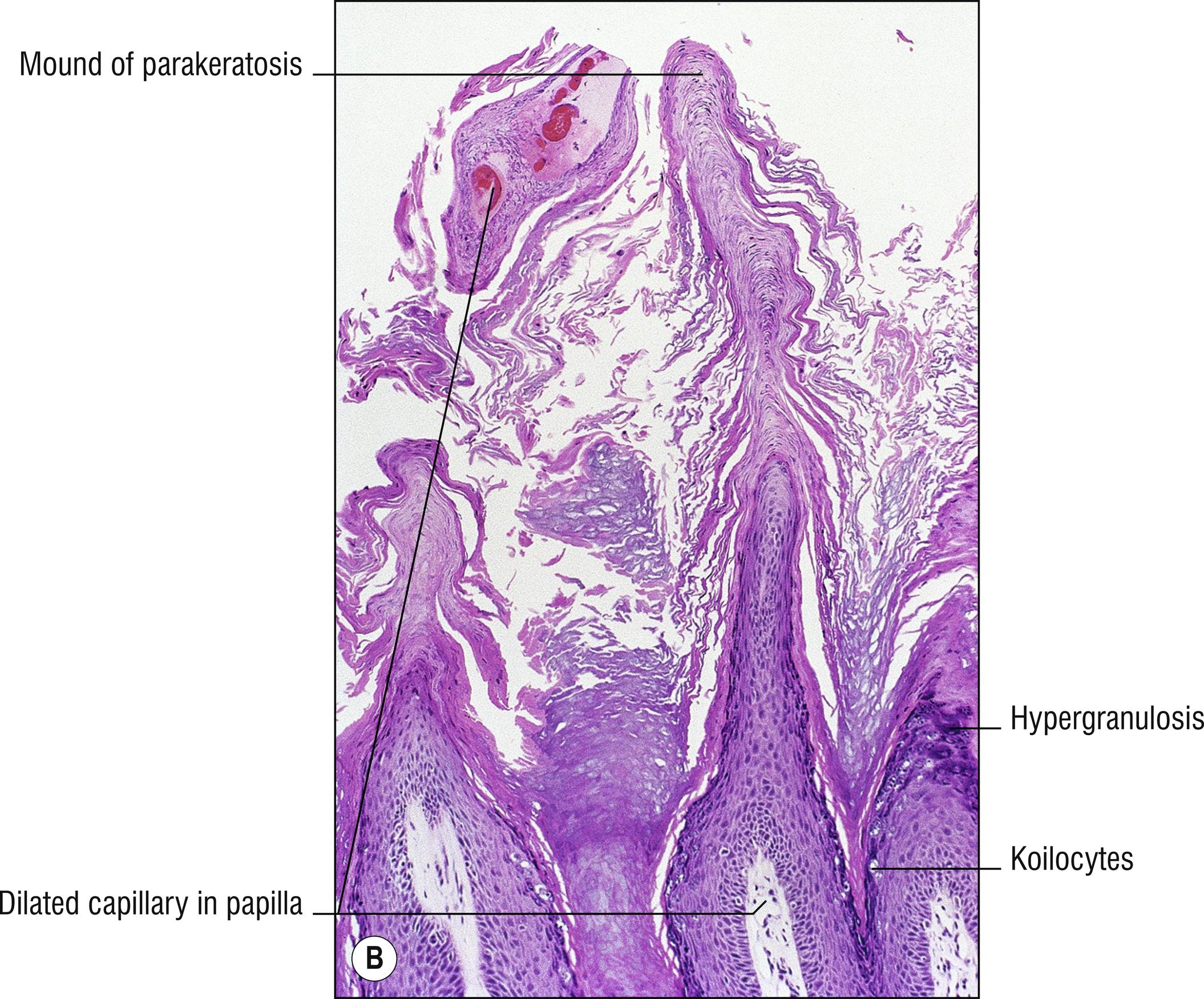 Fig. 14.1, B Verruca vulgaris (medium mag.).