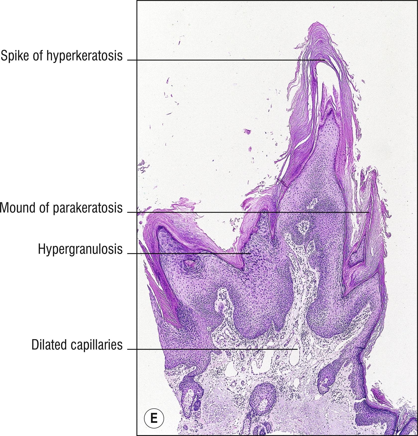 Fig. 14.1, E Filiform wart.