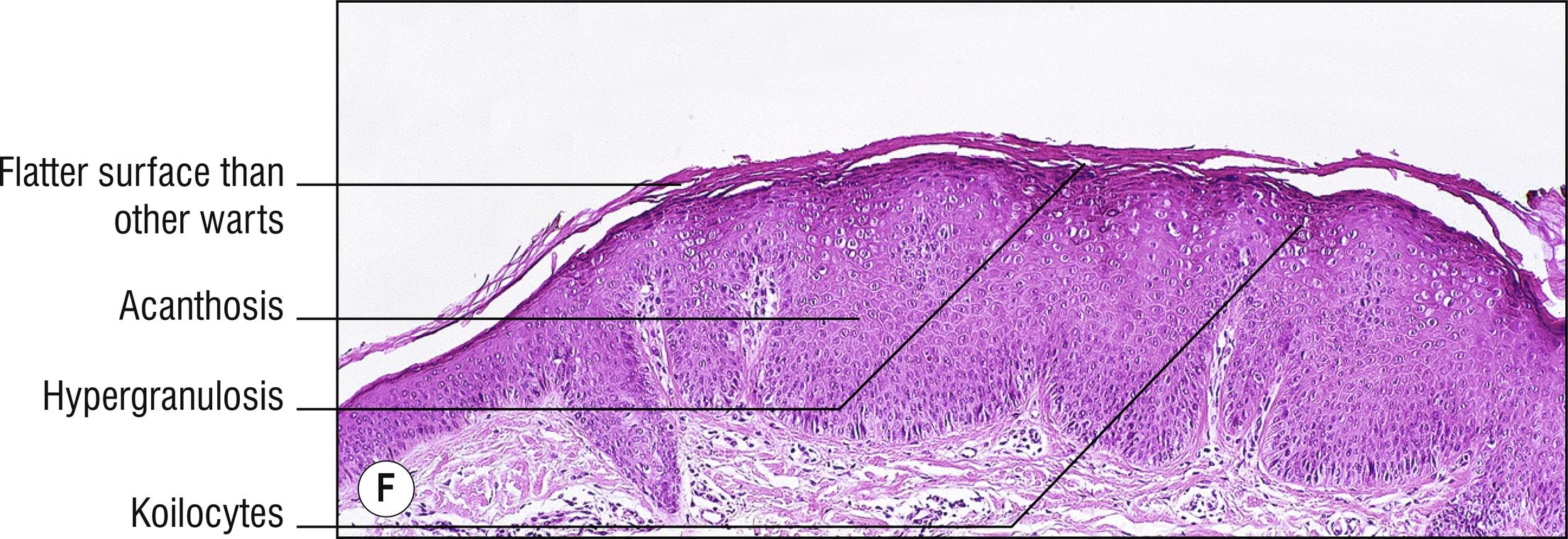 Fig. 14.1, F Verruca plana.