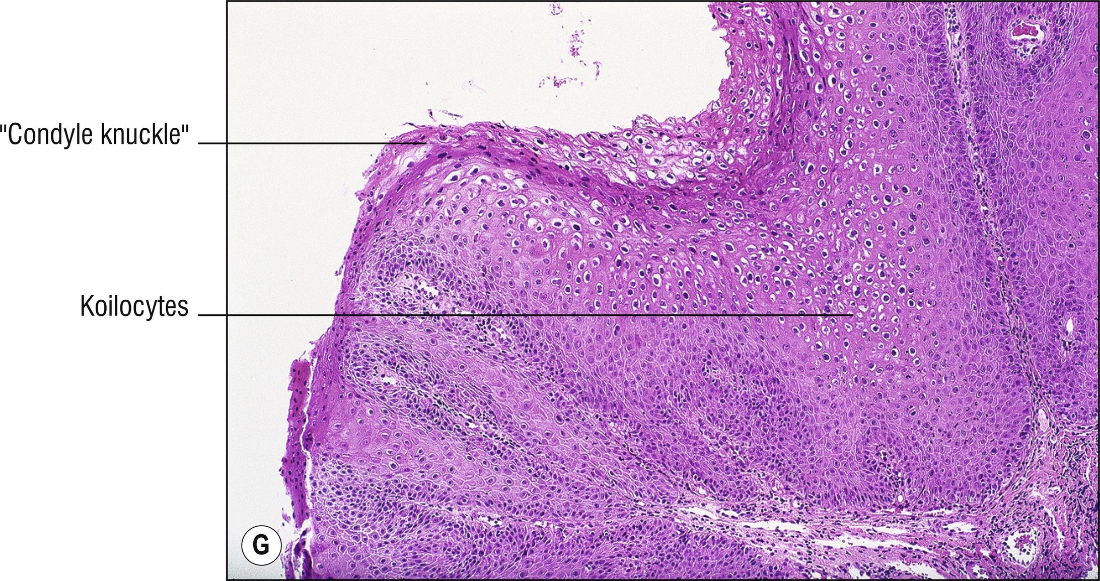 Fig. 14.1, G Condyloma acuminatum.