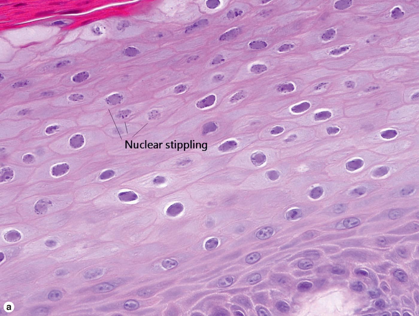 Fig. 19.12, Oral hairy leukoplakia