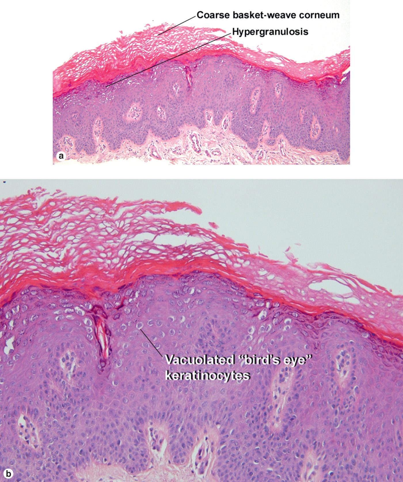 Fig. 19.3, (A and B) Verruca plana. (C) Verruca plana with changes characteristic of epidermodysplasia verruciformis