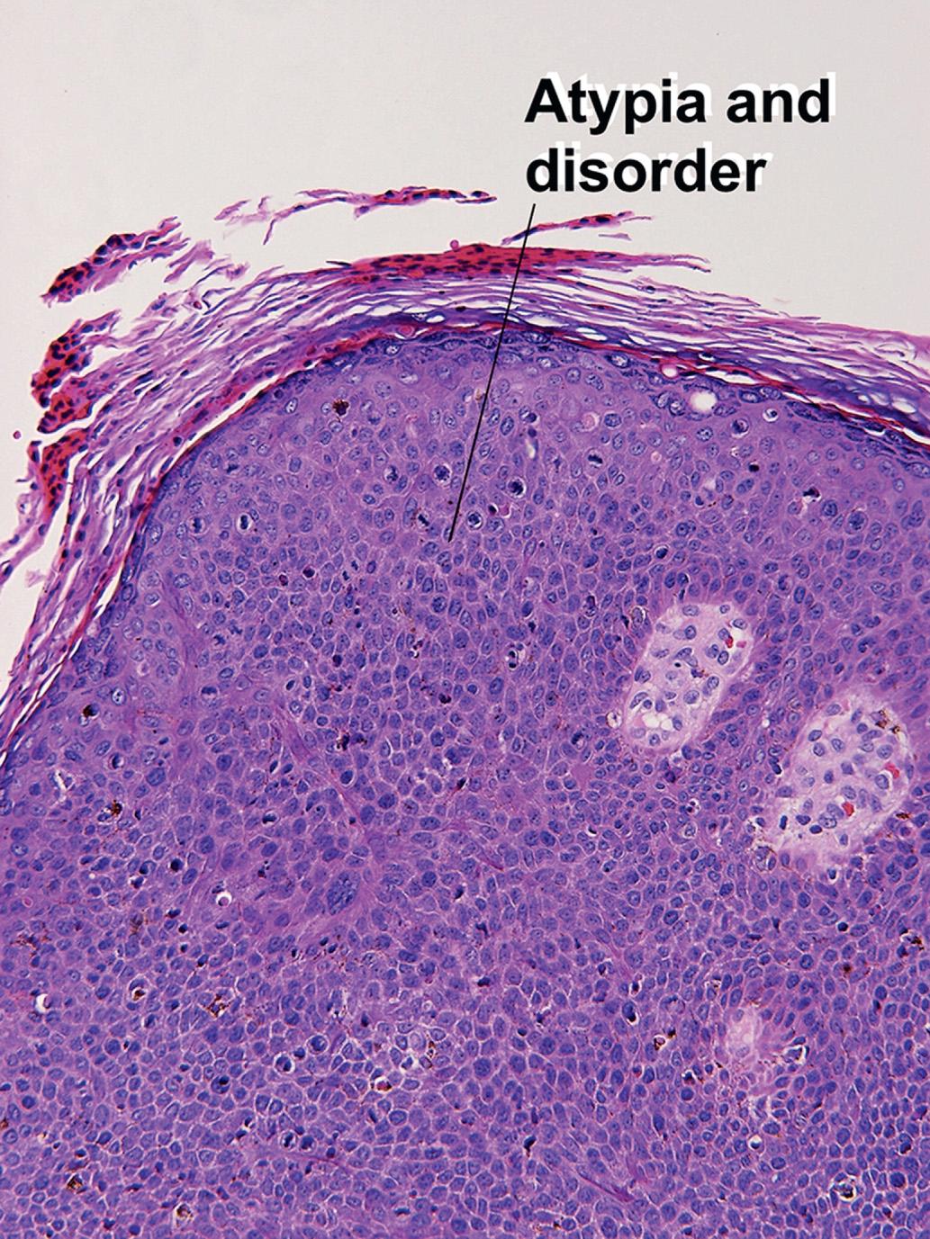 Fig. 19.5, Bowenoid papulosis