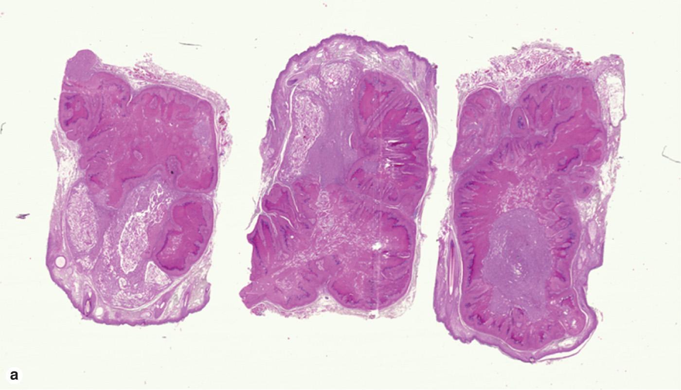 Fig. 19.7, Verrucous cyst