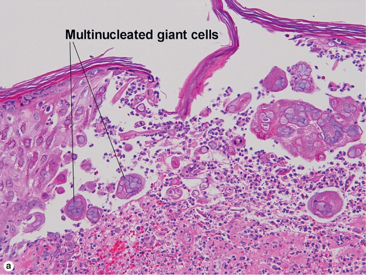 Fig. 19.8, Herpes simplex