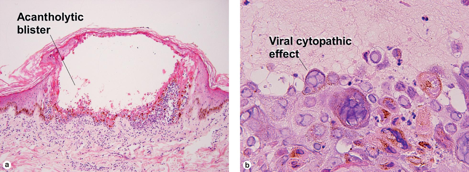 Fig. 19.10, Varicella (chicken pox)