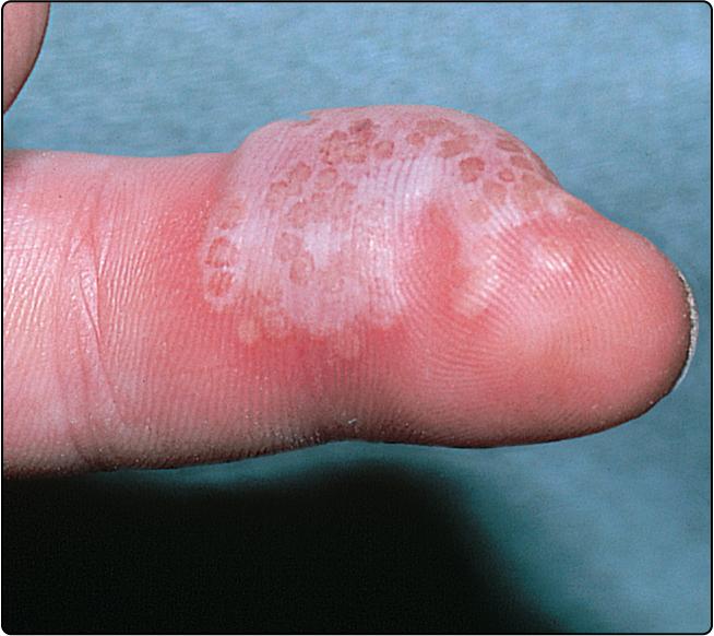 Fig. 30.1, Primary herpes simplex occurring as a herpetic whitlow on a finger.