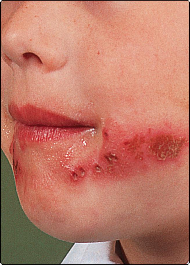 Fig. 30.2, Herpes simplex on the cheek of a child.