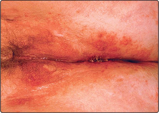 Fig. 30.3, Genital lesions of recurrent herpes simplex.