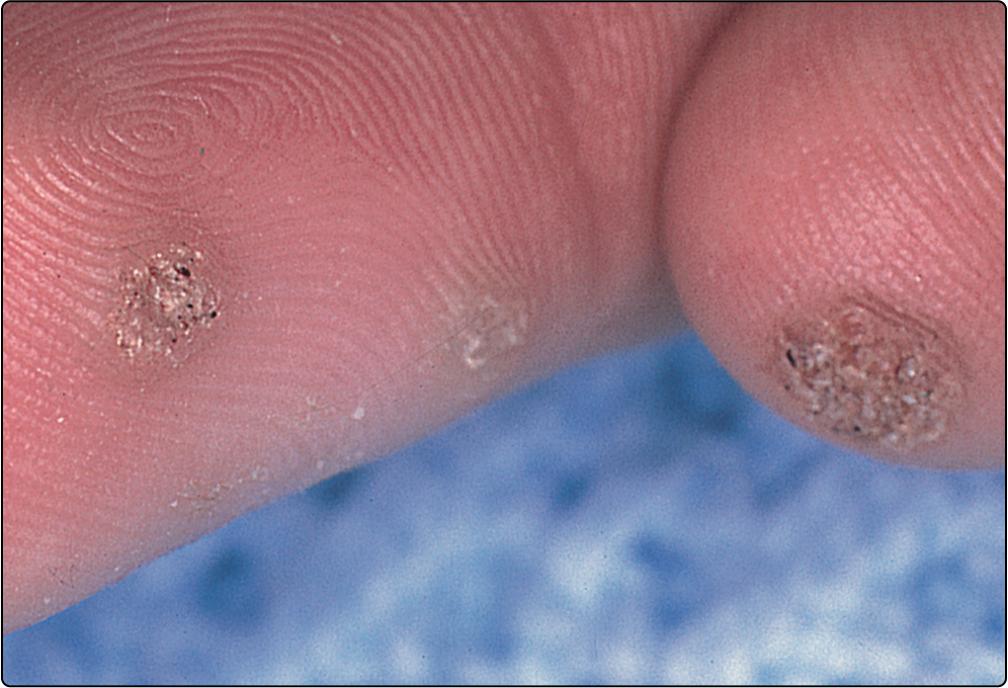 Fig. 29.1, Common viral warts on the hand.