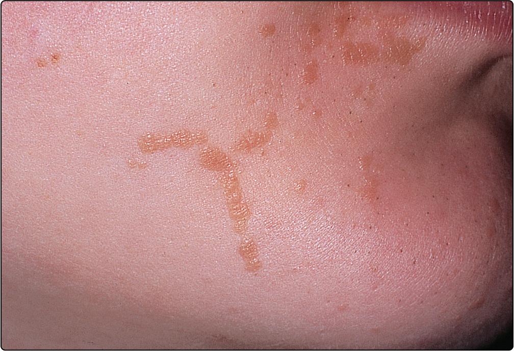 Fig. 29.2, Plane viral warts on the face, showing a linear distribution.