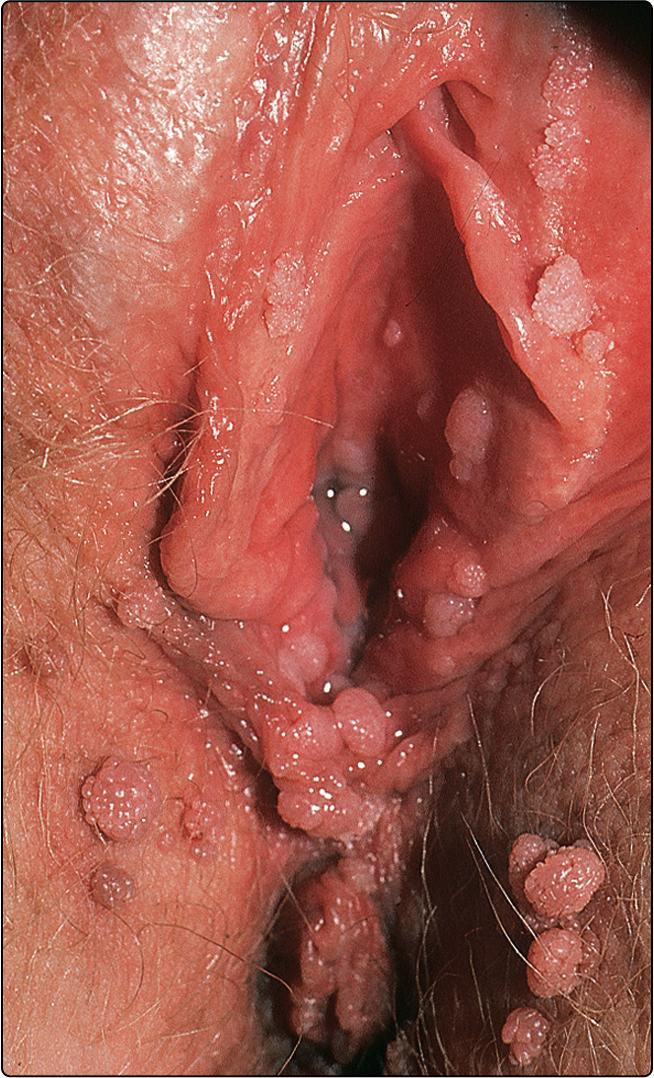 Fig. 29.3, Viral warts on the vulva.