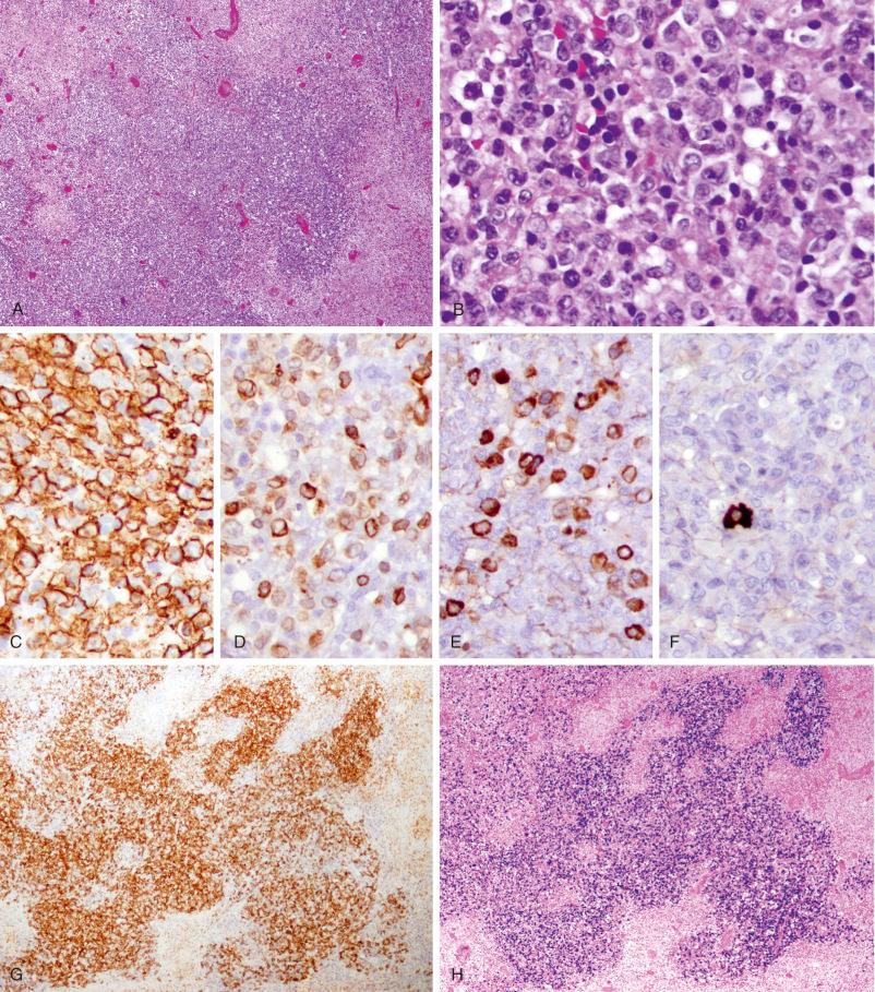 Figure 29-1, Epstein-Barr Virus (EBV)–Positive Diffuse Large B-Cell Lymphoma, Not Specified.