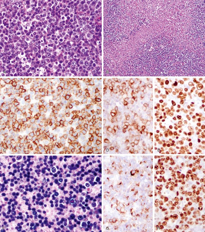 Figure 29-2, Epstein-Barr Virus (EBV)–Positive Diffuse Large B-Cell Lymphoma, Not Specified.