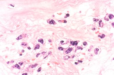 Figure 29-5, Pyothorax-associated lymphoma (diffuse large B-cell lymphoma with chronic inflammation).