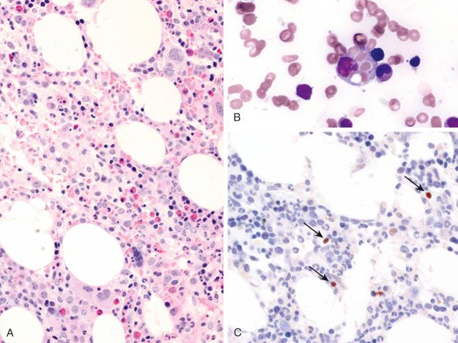 Figure 30-1, Epstein-Barr virus (EBV)–associated hemophagocytic lymphohistiocytosis.