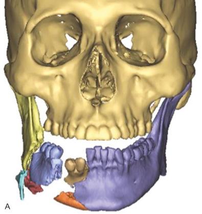 Fig. 3.14.1, Computer-aided design and manufacturing (CAD/CAM) guided repair of complex mandibular fractures sustained in an industrial explosion. Simulated surgical plan illustrating (A) preoperative injury pattern, (B) virtual reduction and restoration of occlusion, and (C) planned placement of custom-milled plate with avoidance of tooth roots.Photographs showing (D) preoperative appearance with extensive soft tissue damage and comminution of mandible and (E) postoperative restoration. The virtual surgical plan and customized titanium plate enabled accurate anatomical alignment allowing for satisfactory postoperative occlusion and restoration of function.