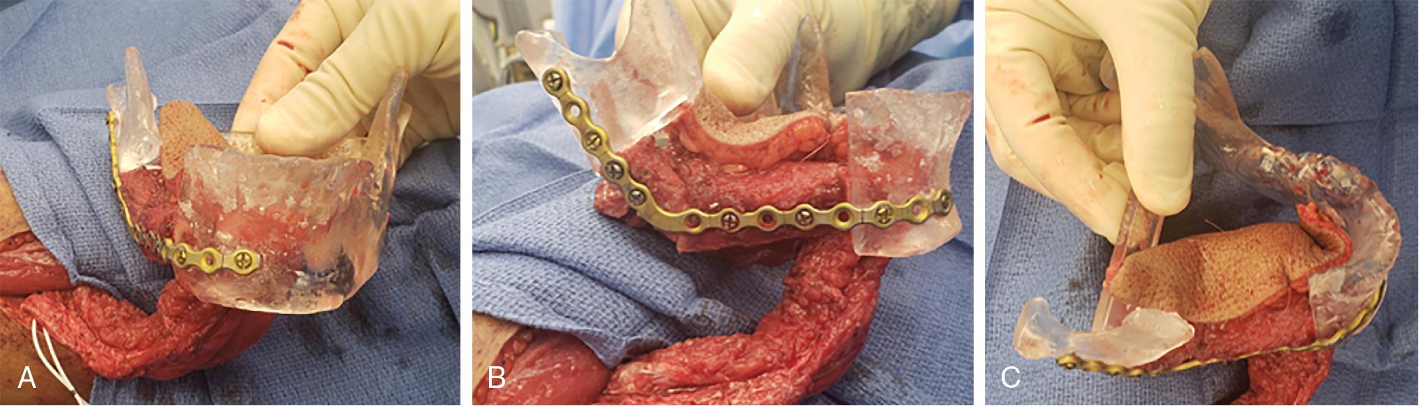 Fig. 24.1, Prefabricated guides, implants, and templates. A three-dimensional printed model of the mandibular defect is used to prefabricate a reconstruction plate preoperatively, and for intraoperative contouring and plating of the fibula construct prior to ischemia time.