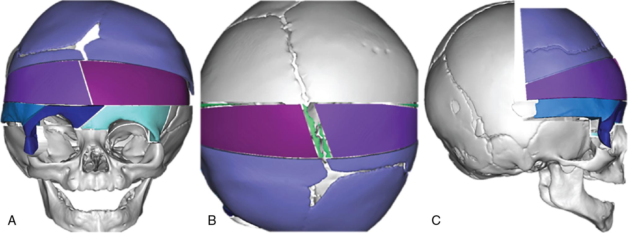 Fig. 24.2, Complex and organic osteotomy patterns are labor-intensive and difficult to simulate using conventional medical modeling software. Owing to software and interface limitations, the end result still may not truly represent the surgeon’s intent.