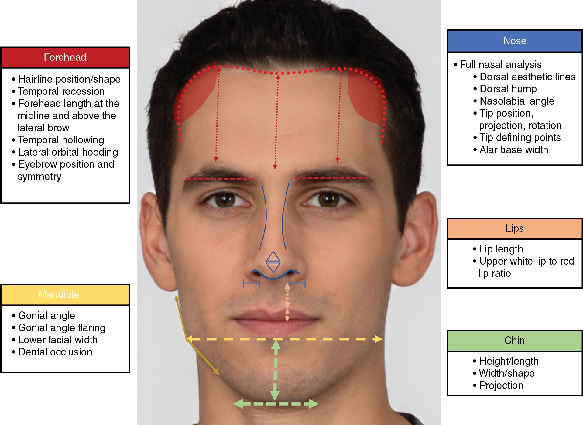 Fig. 23.1, Key clinical examination features in patients considering facial feminization surgery. Vital elements of the facial analysis are displayed and annotated above. A systematic method of clinical examination should be developed to ensure all elements of the facial aesthetic are taken into consideration during consultation. Critical elements to note for computer-assisted design/computer-assisted manufacturing are forehead contour and supraorbital bossing, lower facial width with gonial angle severity and chin position, width, and projection.