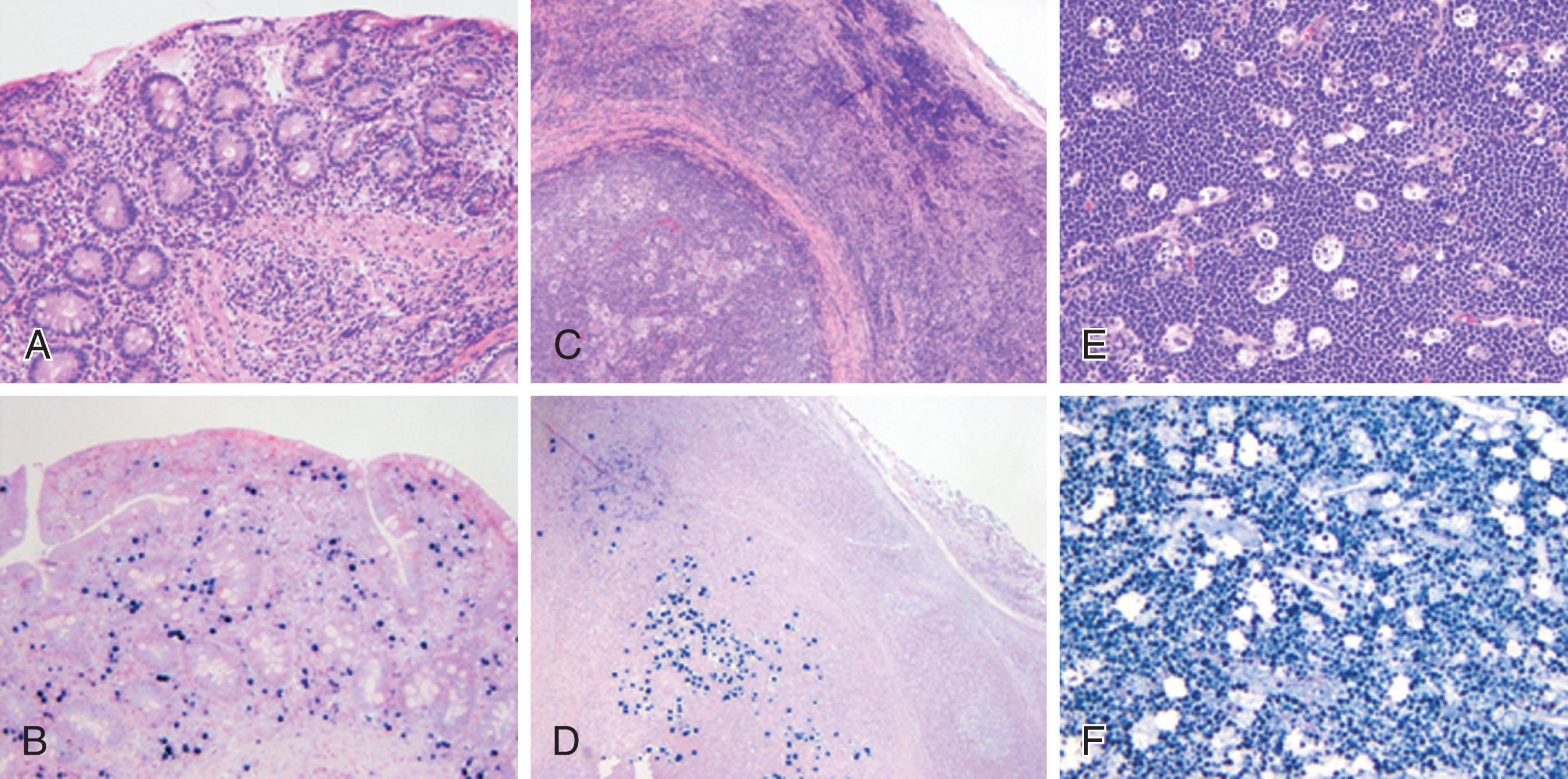 Figure 87.2, EXAMPLES OF EPSTEIN-BARR VIRUS–RELATED LYMPHOMAS.